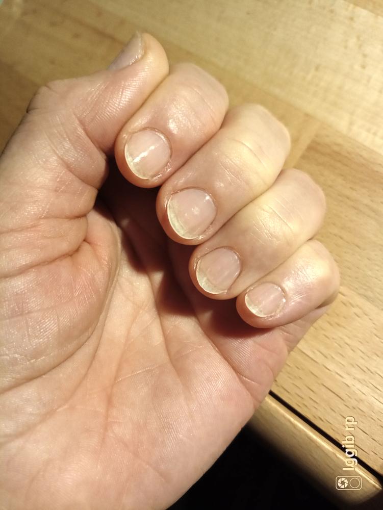 Eingerissener Nagel gerettet