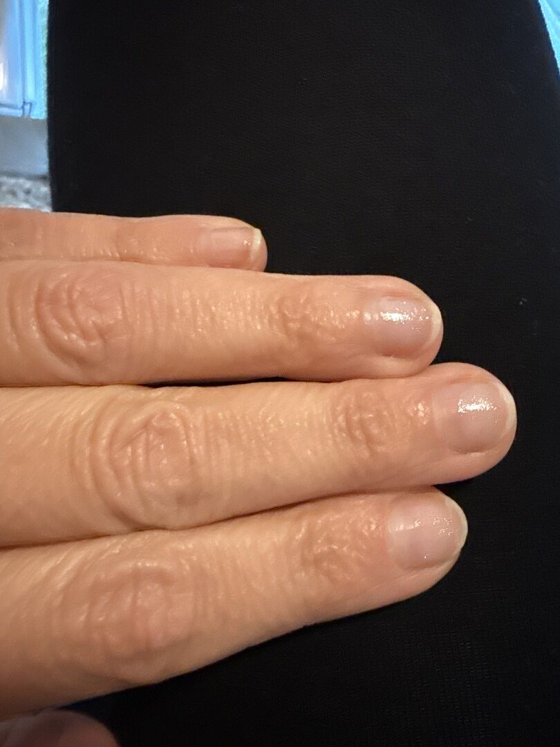 Nach Acryl-Schaden geholfen